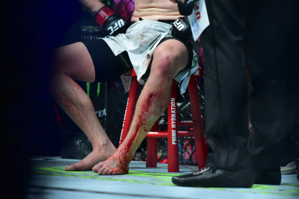 A view of a cut on the shin of Jack Shore during a featherweight bout against Joanderson Brito during the UFC 301 event at Farmasi Arena on May 4, ...