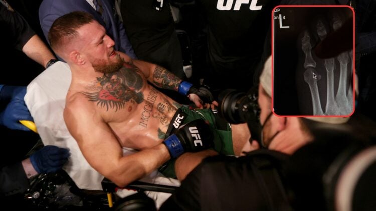 Composite image showing Conor McGregor on a stretcher, with a block that includes an X-Ray of his broken toe