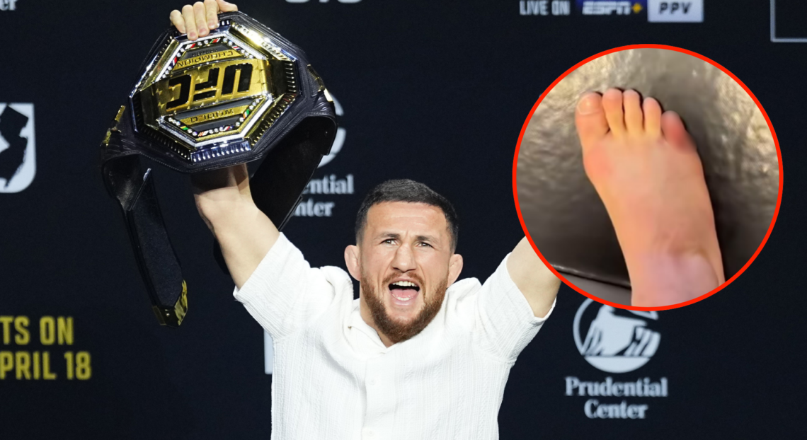 Merab Dvalishvili holds aloft his UFC belt (upside down) in main photo. Bubble to the right shows his broken toe which has been blurred