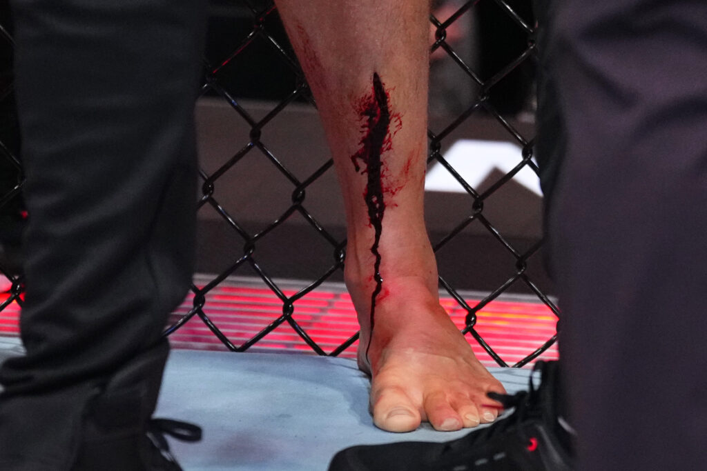 Image of Stephen Thompson's shin split open during his fight at UFC Nashville