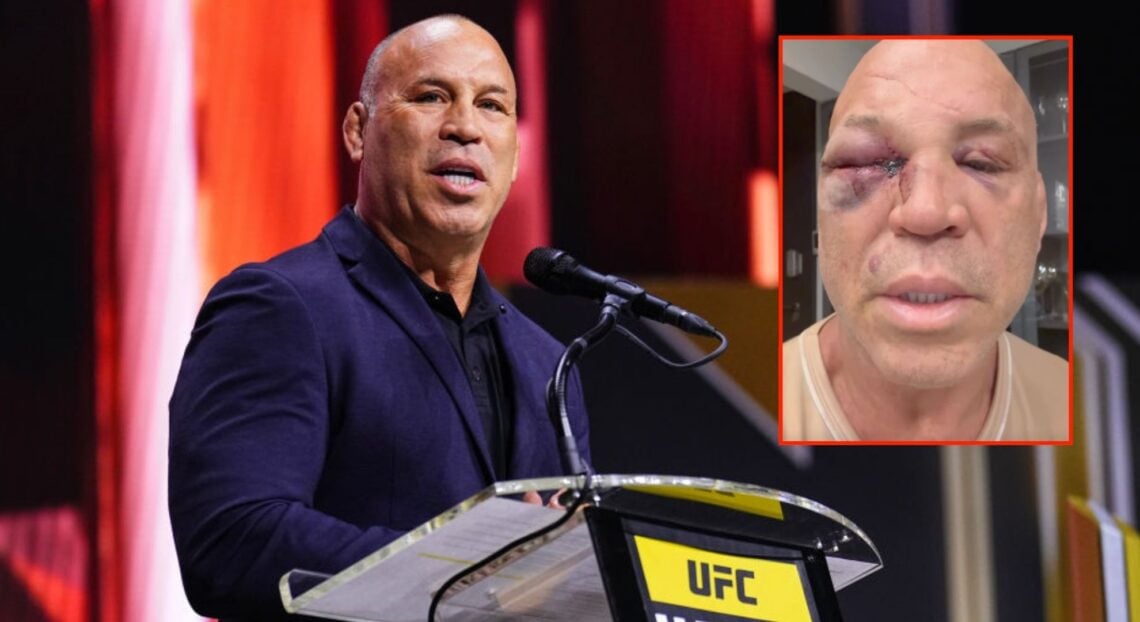 Wanderlei Silva at the 2024 UFC Hall of Fame induction ceremony, inset of him showing of his injuries on Instagram