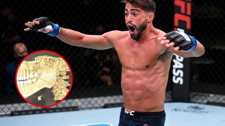 Main: Randy Costa reacts after knocking out Journey Newsom in their UFC Fight Night bout. Inset: X-ray image of Randy Costa's broken jaw after a Mu...