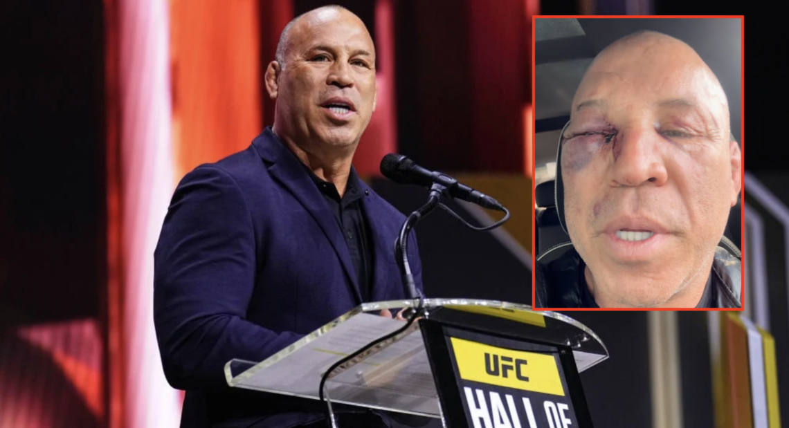 Wanderlei Silva speaks at the UFC Hall of Fame Ceremony, inset of his bruised after a comeback disaster