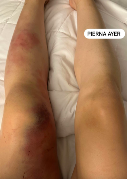 Irene Aldana's leg before and after her fight with Karol Rosa at UFC 296.